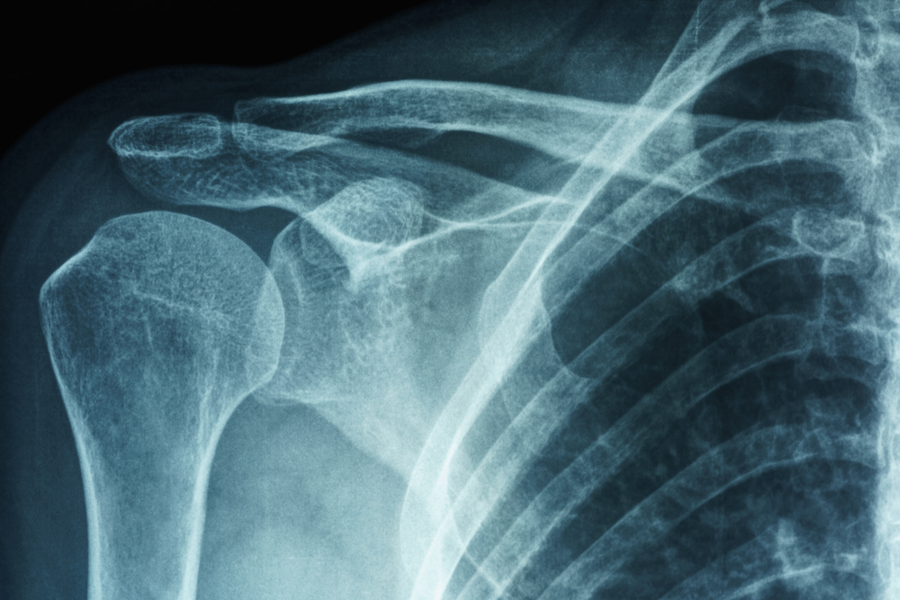 Capsulite adesiva do ombro: causas, sintomas e tratamento