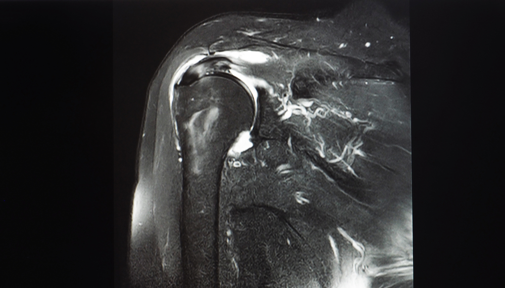 Cirurgia de capsulite adesiva do ombro