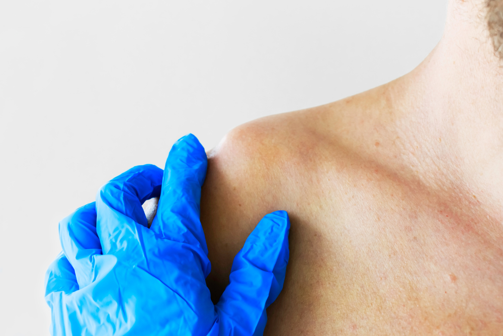 Cirurgia para luxação de ombro