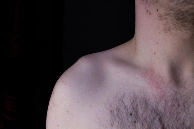 Ombro com luxação acromioclavicular