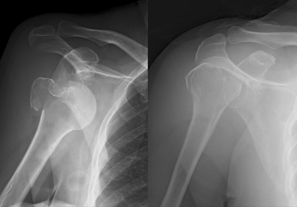 Como é a recuperação da cirurgia para a luxação do ombro?