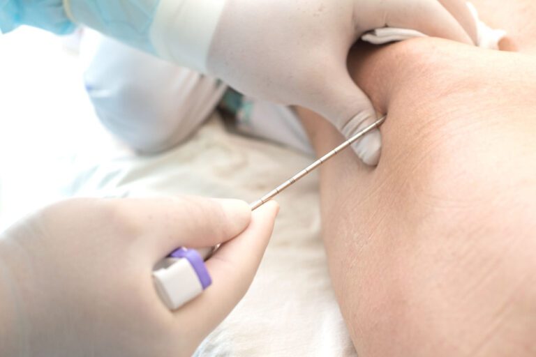 Médico usando uma agulha longa, perfura o ílio de uma criança para diagnosticar a medula óssea.