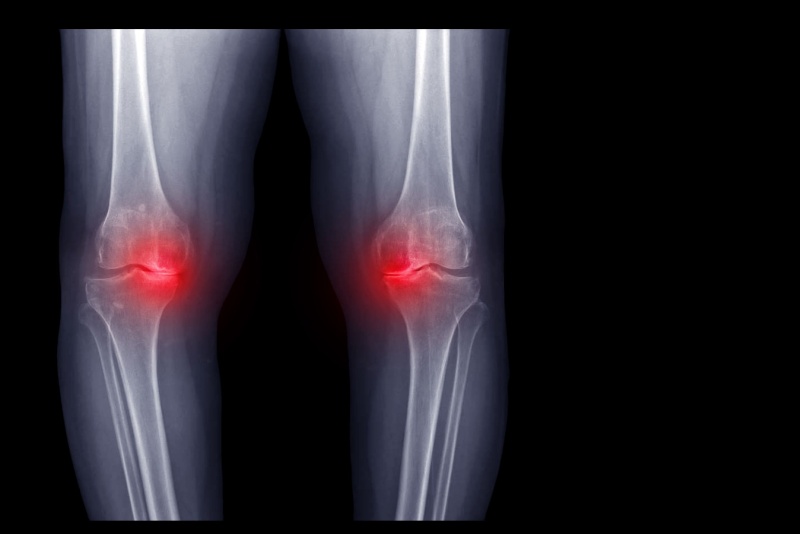 Artroplastia parcial de joelho: o que é, indicações e recuperação