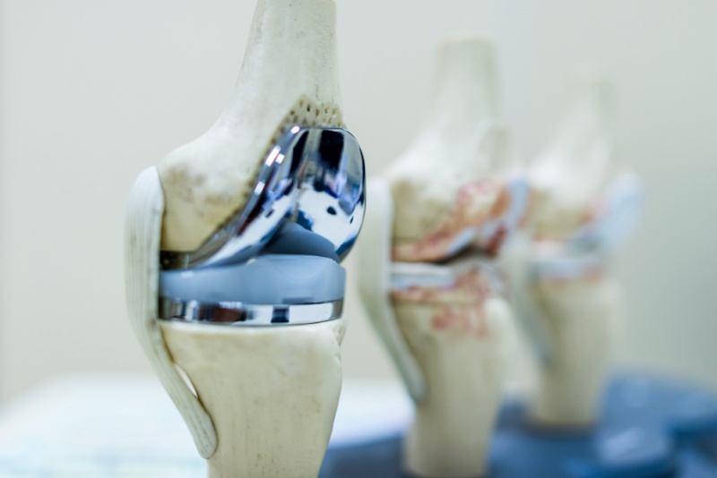 Artroplastia total de joelho: quando é indicada, como é a cirurgia e recuperação