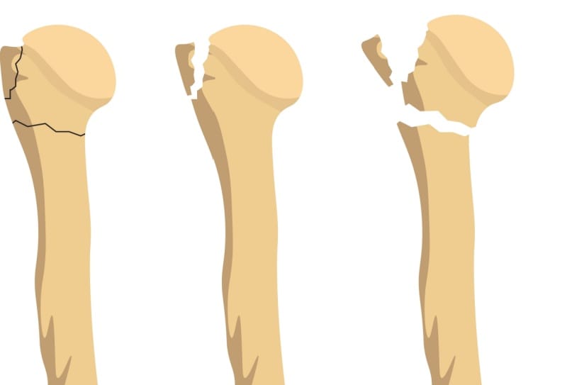 Fratura do úmero (fratura do braço): diagnóstico, tratamento e cirurgia